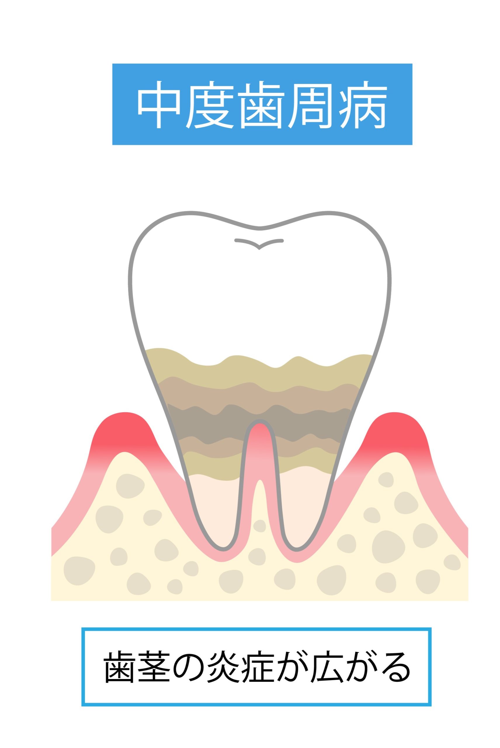 中度歯周炎