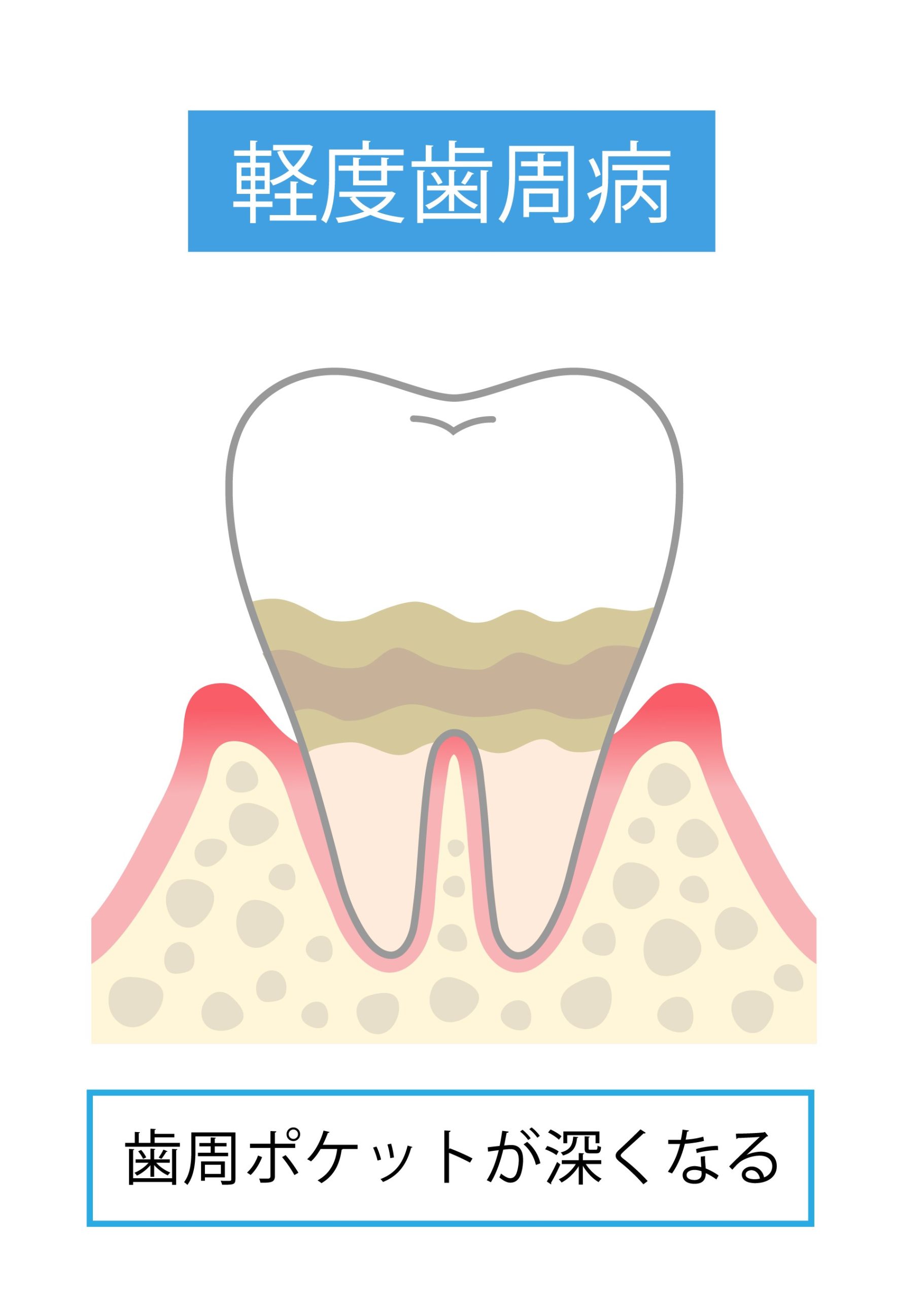 軽度歯周炎